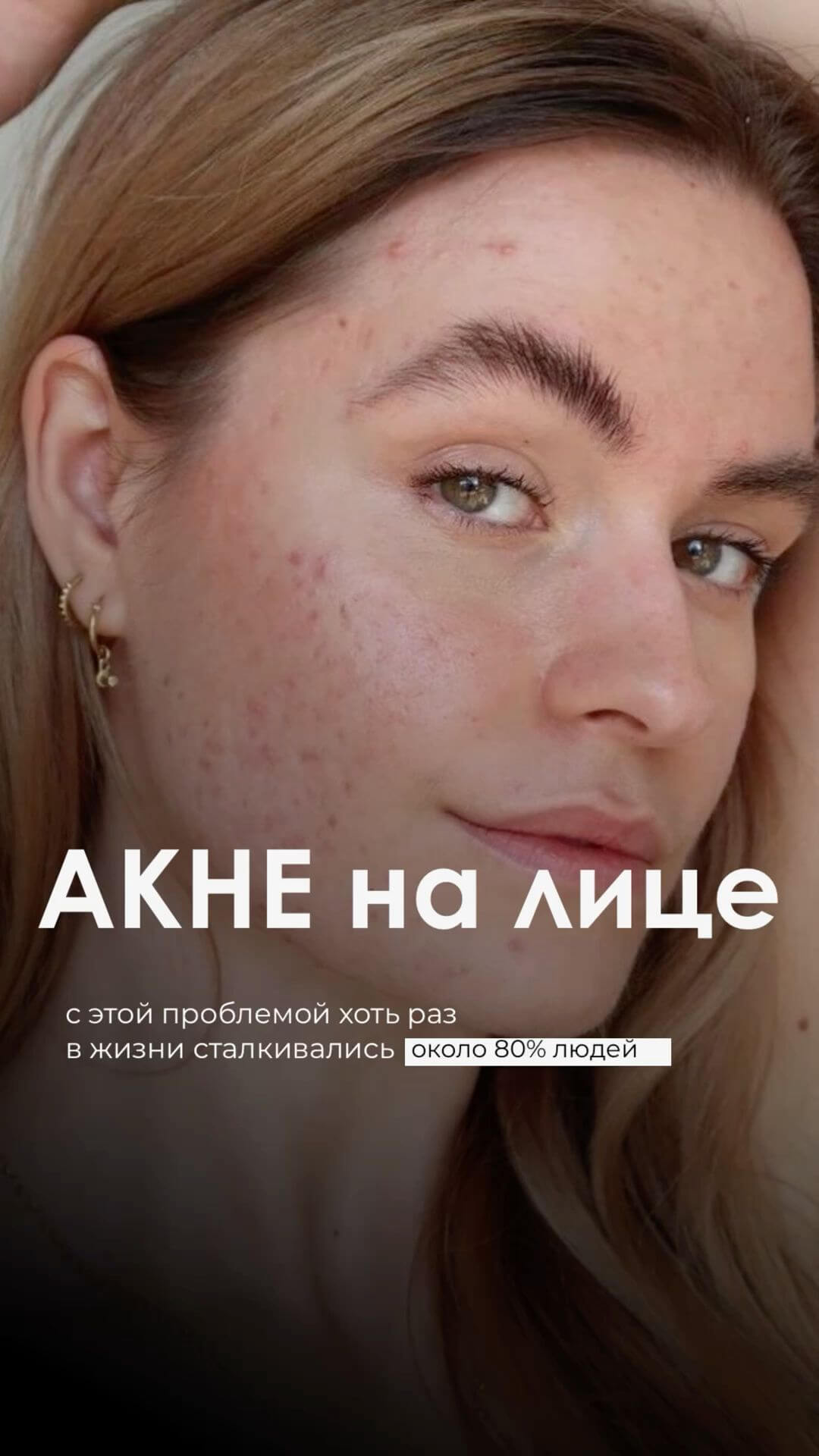 Акне на лице